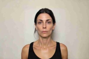 Read more about the article Beyond “Ozempic Face”: The Medical Protocol for Preserving Skin Structure During Rapid Weight Loss