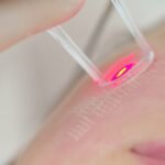 Why Autumn and Winter Are the Official “Laser Season” for Skin Resurfacing