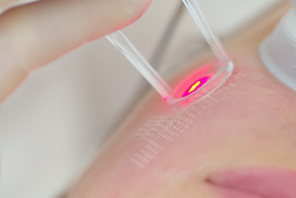 You are currently viewing Why Autumn and Winter Are the Official “Laser Season” for Skin Resurfacing
