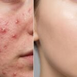 Active Breakouts vs. Permanent Scars: Why Timing Matters for Laser Resurfacing