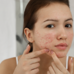 Erasing the Past: The Micro-Architectural Science of CO2 Laser Acne Scar Remodeling