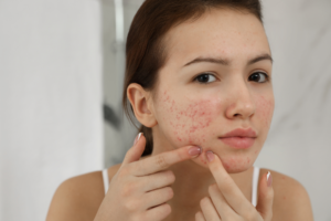 Read more about the article Erasing the Past: The Micro-Architectural Science of CO2 Laser Acne Scar Remodeling