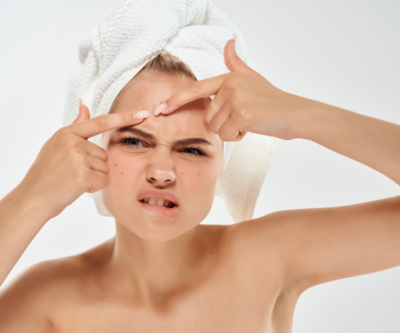 How popping pimples damages skin collagen and leads to acne scars